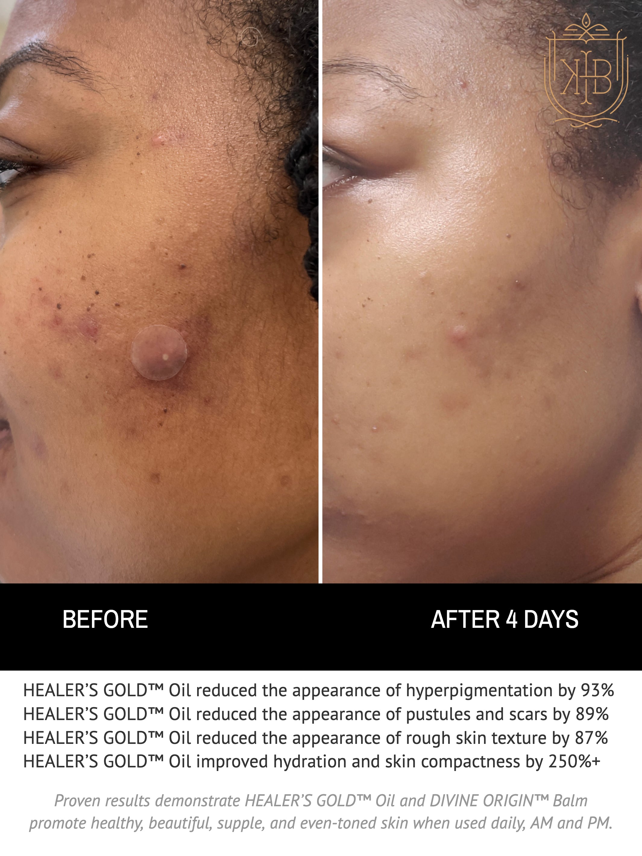 HEALER’S GOLD™ Oil reduced the appearance of hyperpigmentation by 93%, educed the appearance of pustules and scars by 89%, improve rough skin texture by 87%, and improved hydration, elasticity, and skin compactness by 250%+. Proven results demonstrate HEALER’S GOLD™ Oil and DIVINE ORIGIN™ Balm promote healthy, beautiful, supple, and even-toned skin when used daily, AM and PM.