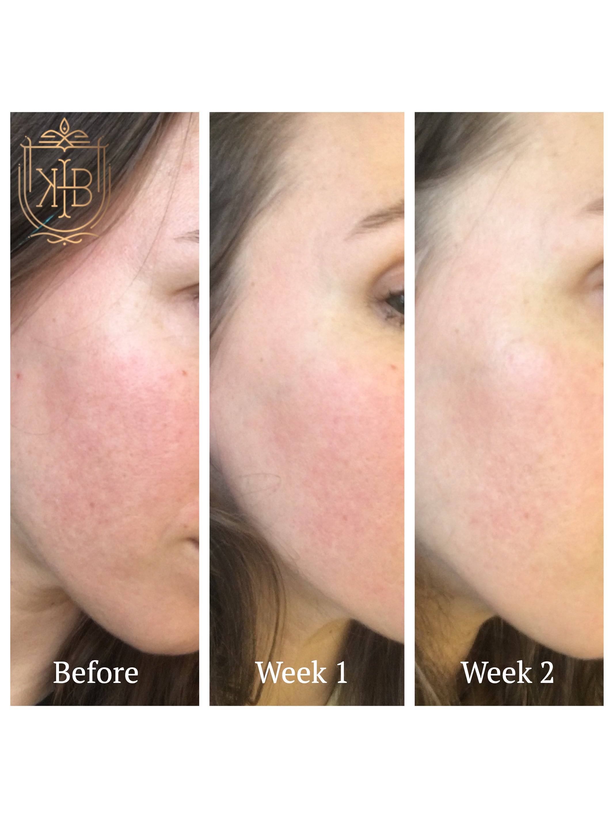 How to repair and reverse skin damage, acne scars, and redness. Effective results that are therapeutic and non-irritating with our Repair Skin Ritual. 100% natural skincare products from West Africa.